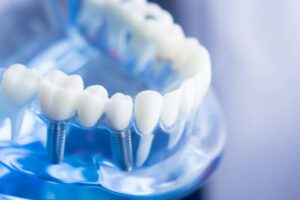 Prosthetic Dentistry