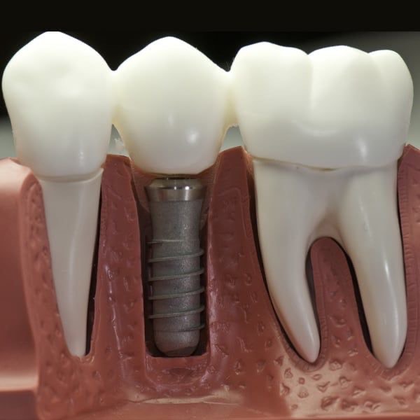 Prosthetic Dentistry Sandton Dentist Sandton